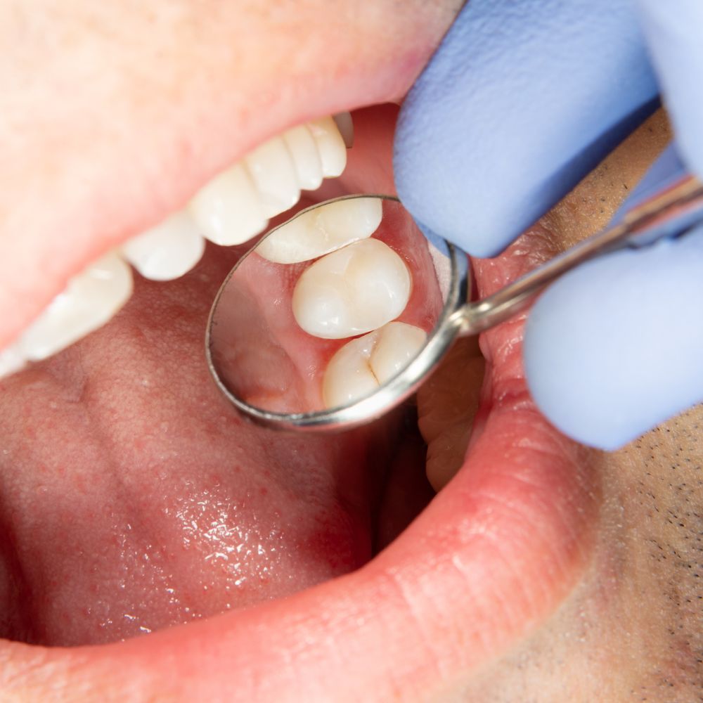 An image of Dr. Theodora Bravis at Thames Dental looking into someone's mouth - a focus on upper teeth.