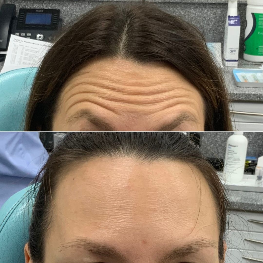 Dr Theodora Bravis Before and after images of anti-wrinkle injections treatment for forehead wrinkles at Thames Dental and Skin, Thames Ditton in Surrey