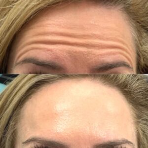 Dr Theodora Bravis Before and after results of anti-wrinkle injections treatment for forehead lines at Thames Dental and Skin in Thames Ditton in Surrey