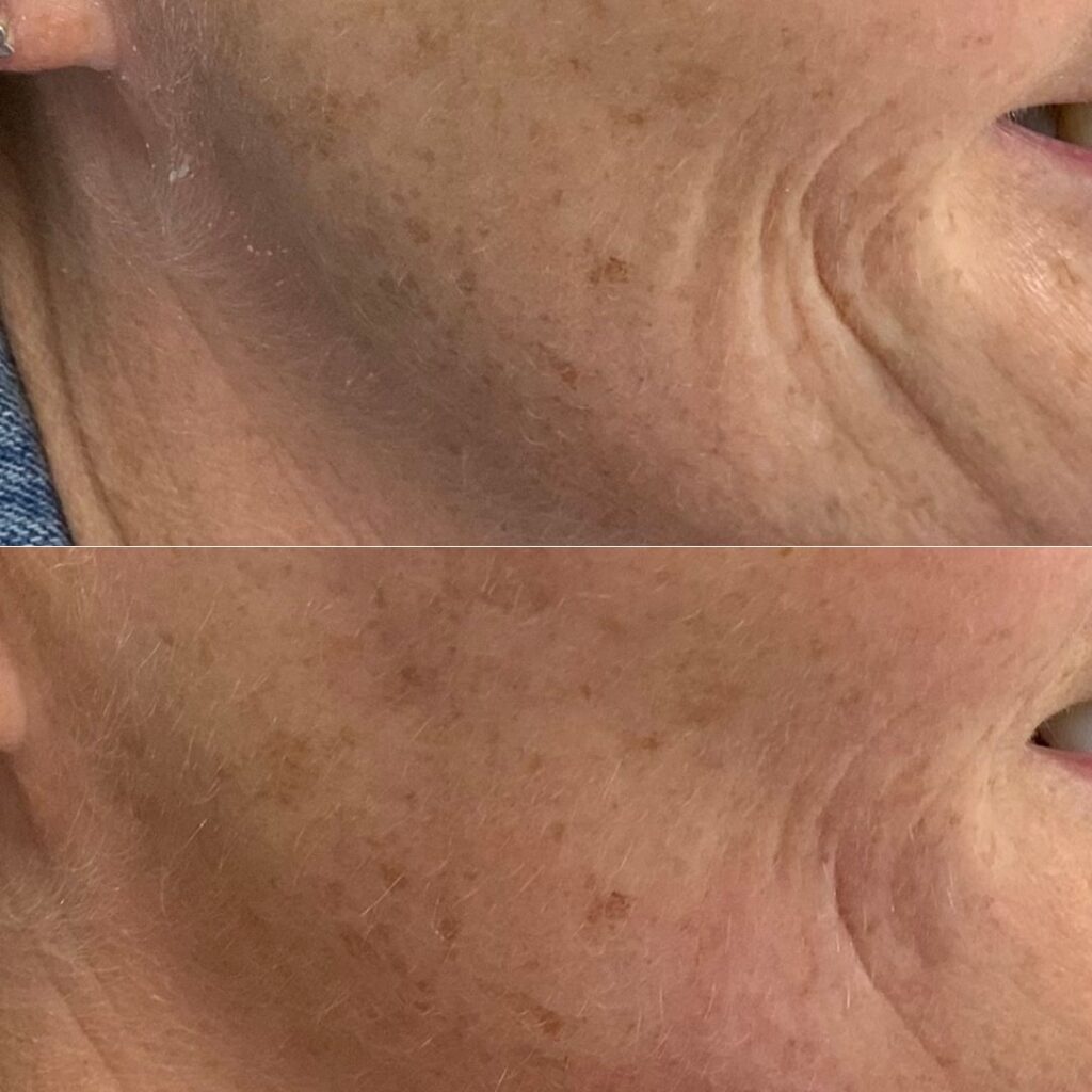 Before and after images of HarmonyCA treatment illustrating the reduction of nasolabial folds and marionette lines at Thames Dental and Skin, Thames Ditton in Surrey by Dr Theodora Bravis