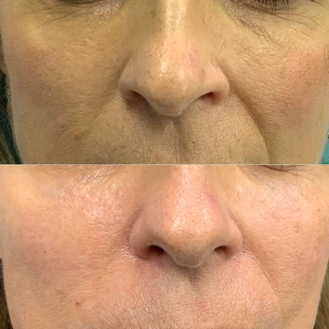 ULTRACEL2 non-surgical facelift before and after results by Dr. Theodora Bravis at Thames Dental and Skin, Surrey, highlighting the lifting and tightening effects on the mid-face region using HIFU, Micro-needling, and Radio-frequency