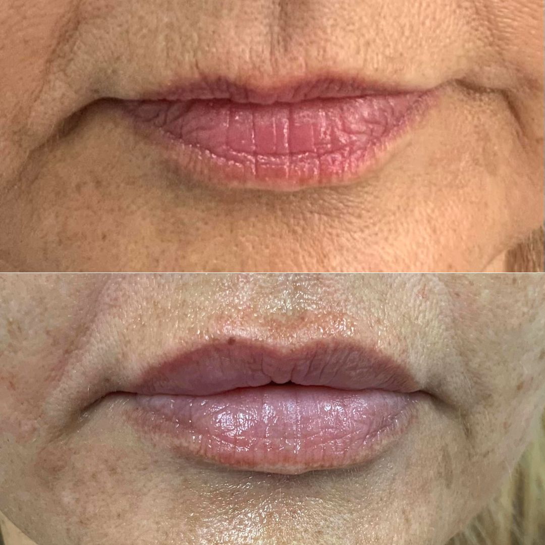 Lip filler before and after results showcasing enhanced lip volume and definition, performed by Dr. Theodora Bravis at Thames Dental and Skin in Thames Ditton, Surrey