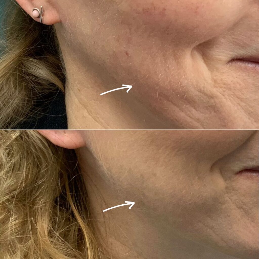 Before and after images of Profhilo treatment demonstrating an overall improvement in skin health and radiance, achieved by Dr. Theodora Bravi at Thames Dental and Skin, Surrey