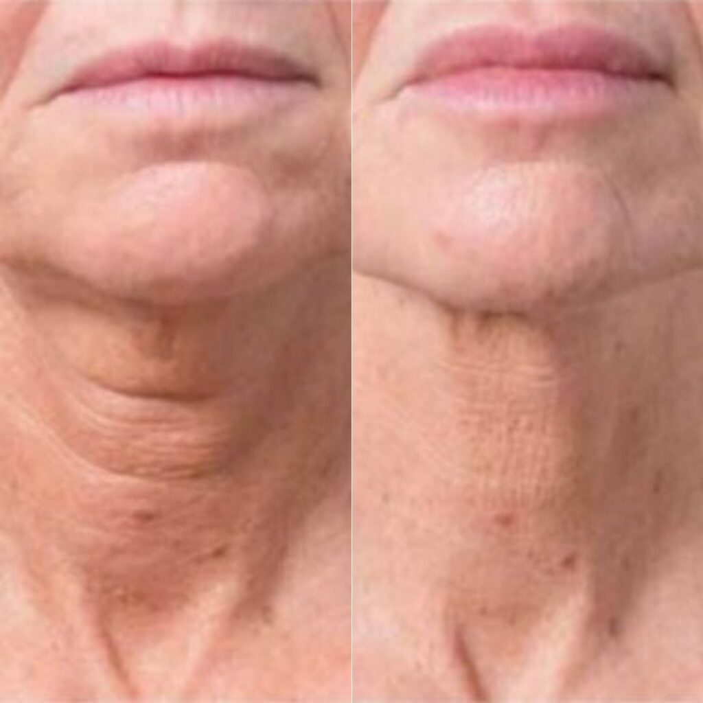 Before and after images of Profhilo treatment illustrating a noticeable improvement in skin quality and overall appearance in the neck, achieved by Dr. Theodora Bravis at Thames Dental and Skin, Surrey