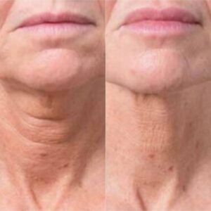 Before and after images of Profhilo treatment illustrating a noticeable improvement in skin quality and overall appearance in the neck, achieved by Dr. Theodora Bravis at Thames Dental and Skin, Surrey