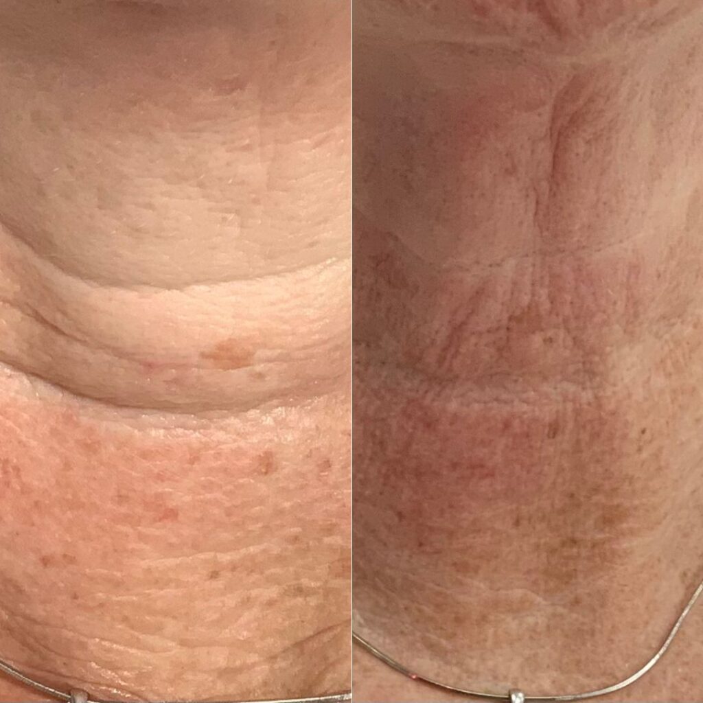 Profhilo before and after results highlighting the skin's increased suppleness and resilience in the neck, performed by Dr. Theodora Bravis at Thames Dental and Skin in Thames Ditton, Surrey