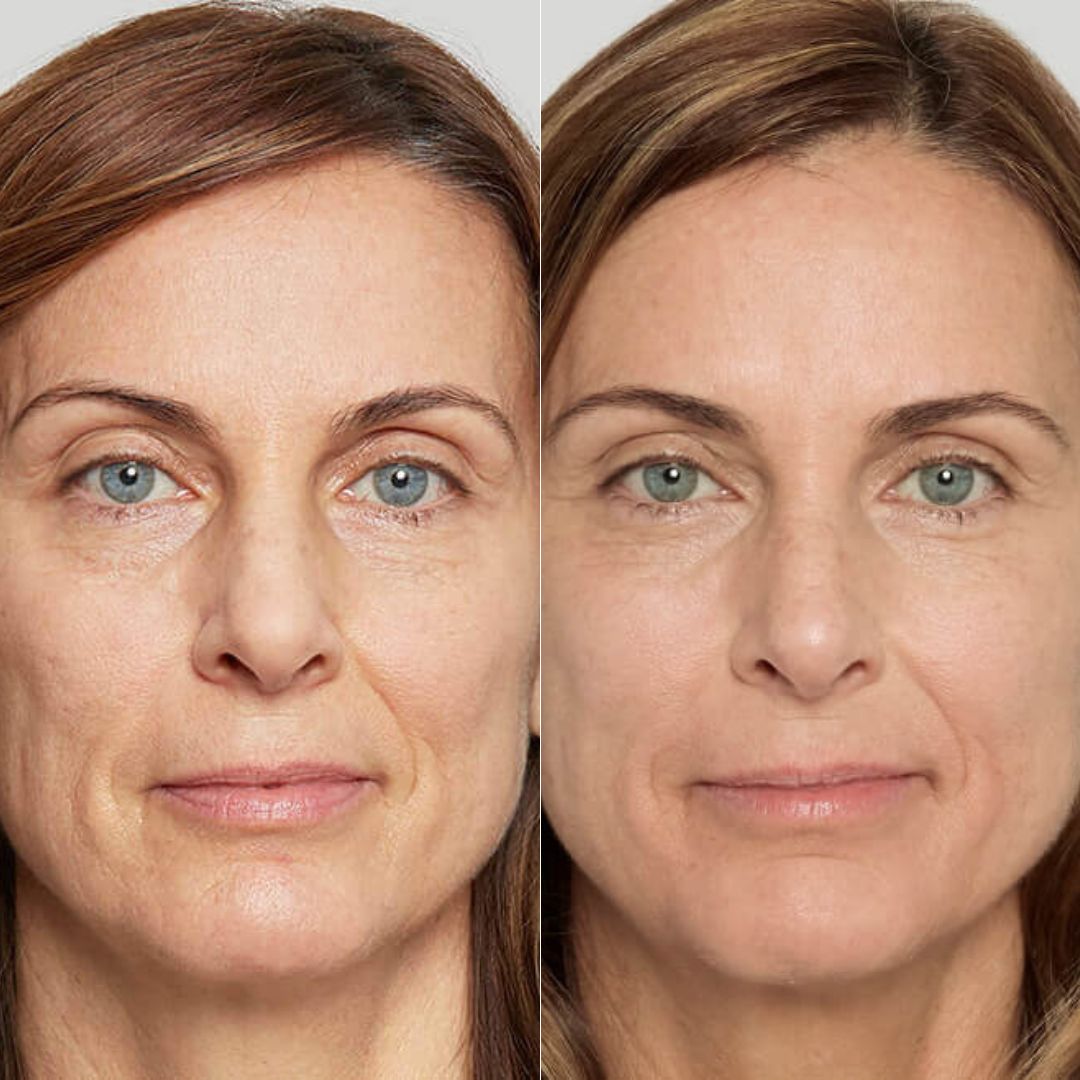 Profhilo before and after results revealing a more youthful and radiant complexion, performed by Dr. Theodora Bravis at Thames Dental and Skin in Thames Ditton, Surrey