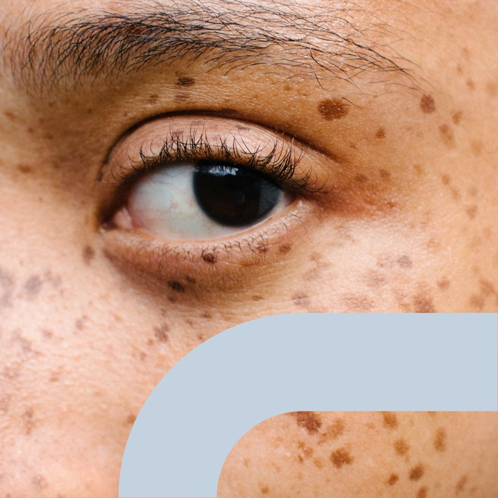 Non-Surgical Blepharoplasty