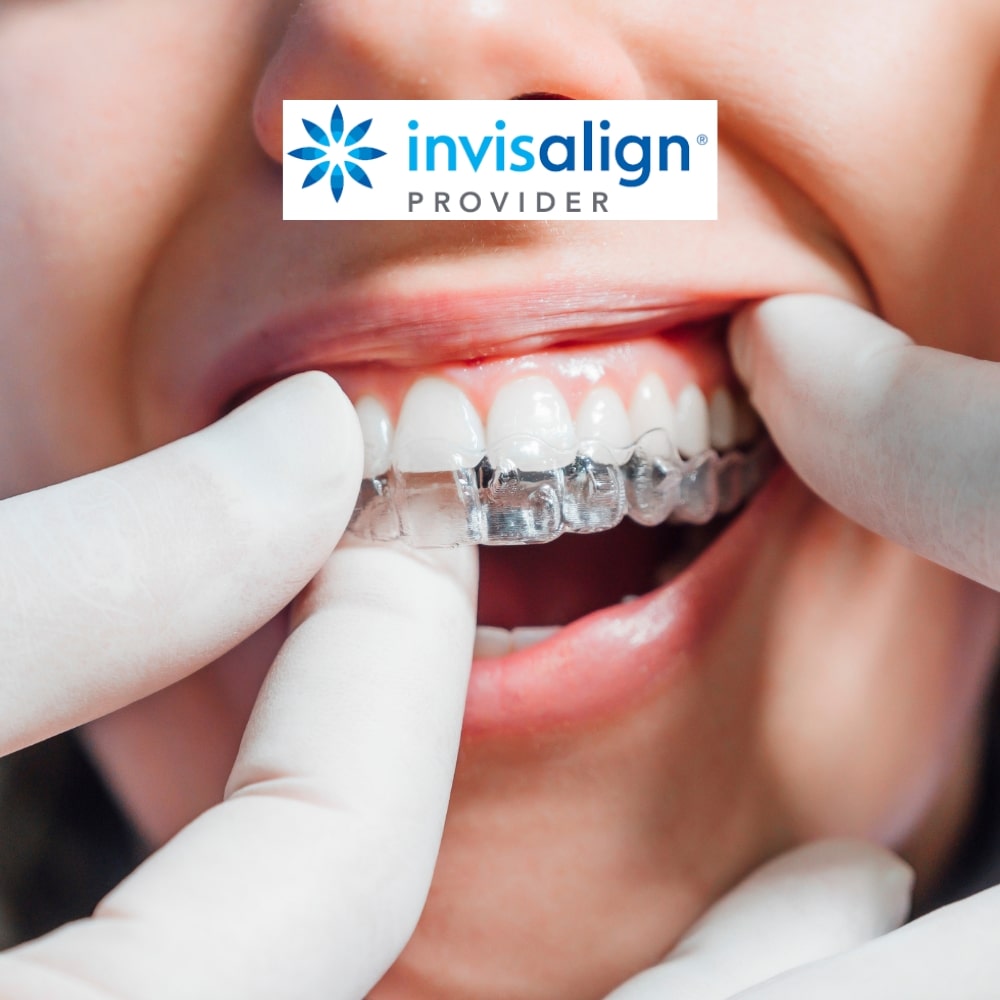 Dentist adjusting clear Invisalign aligners on a patient's teeth to ensure a perfect fit.