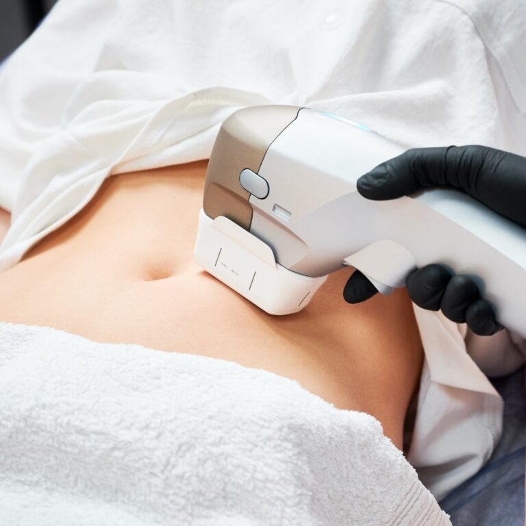 Profound RF microneedling treatment being performed on a woman's abdomen to tighten loose skin and improve firmness.