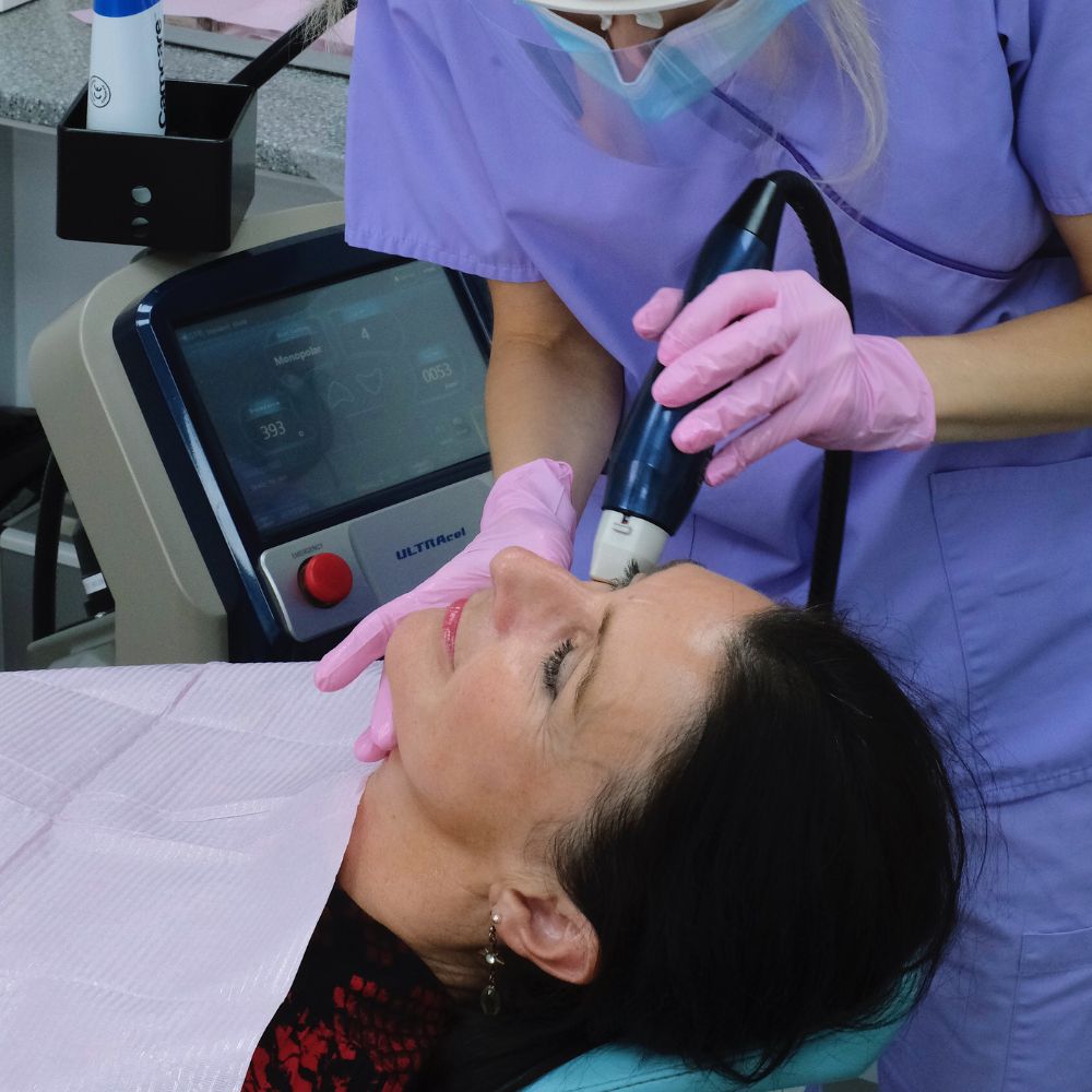 what is rf microneedling