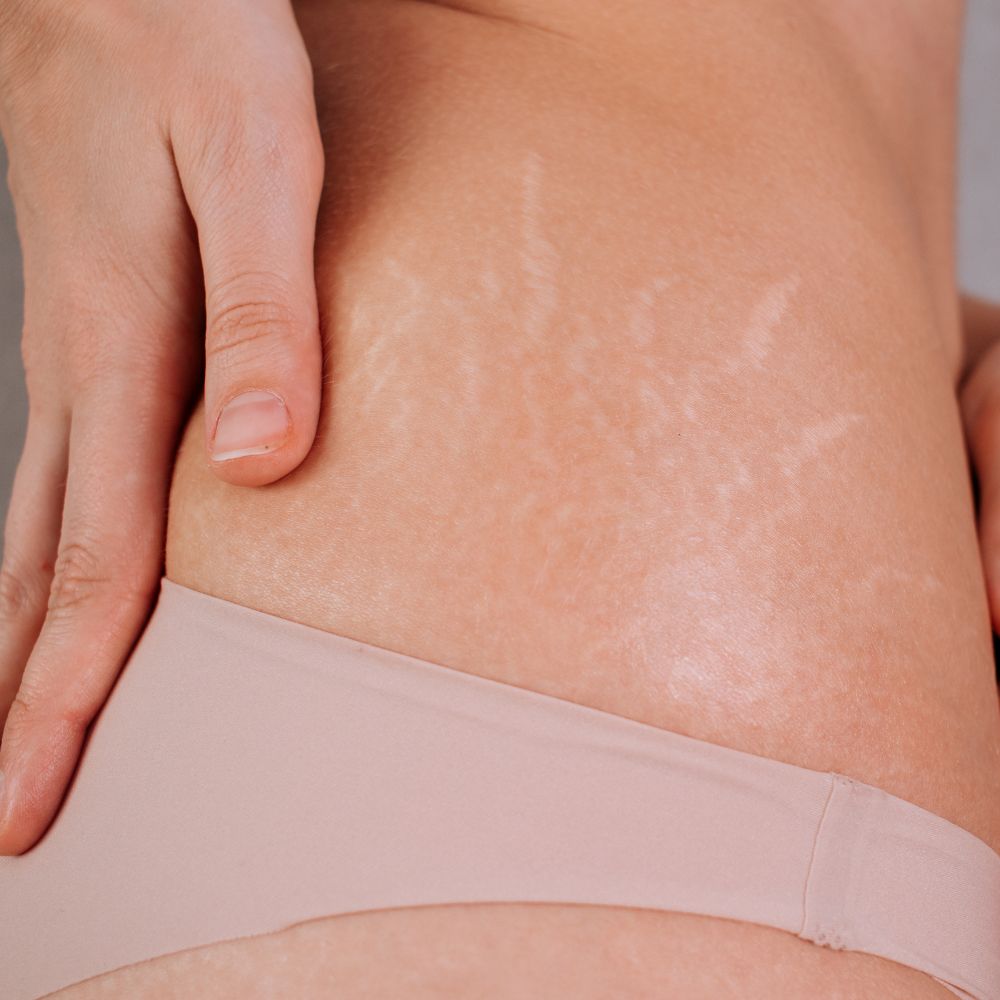 stretch marks treatment in thames ditton