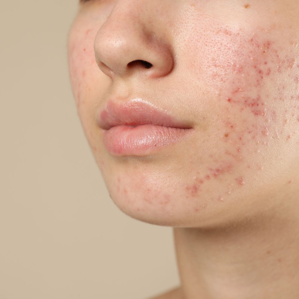 Acne scarring treatment options in Thames Ditton